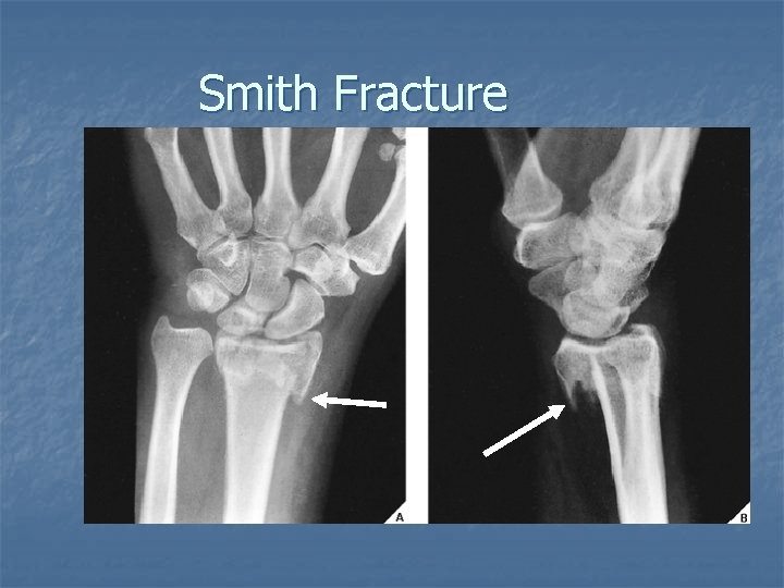 Smith Fracture 