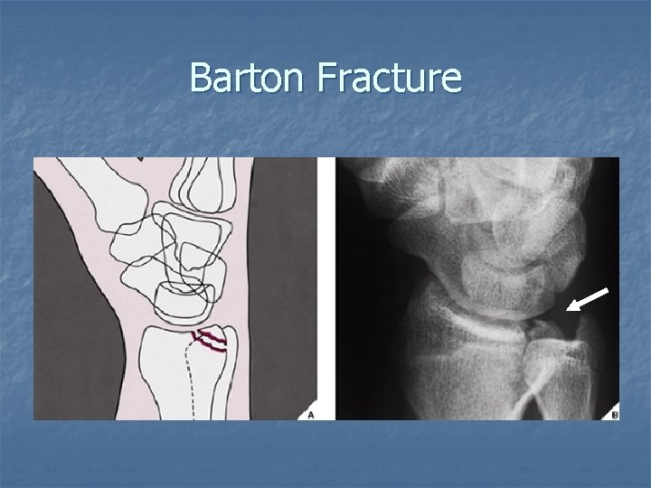 Barton Fracture 