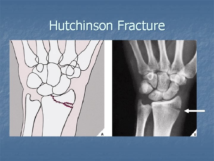 Hutchinson Fracture 
