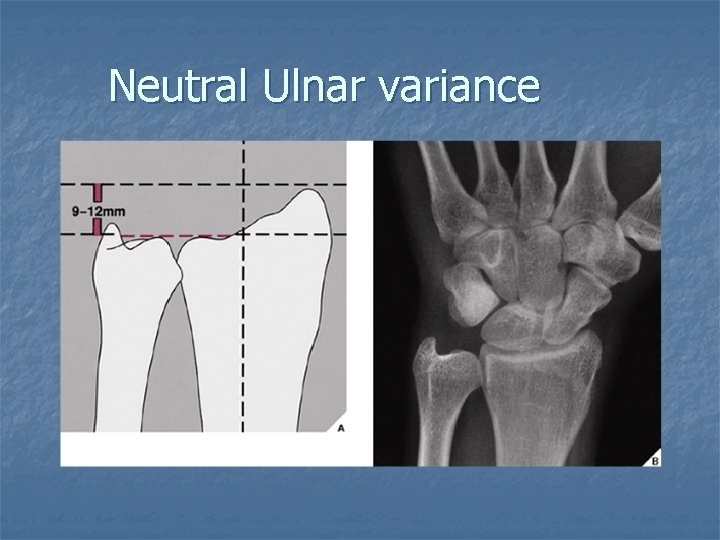 Neutral Ulnar variance 