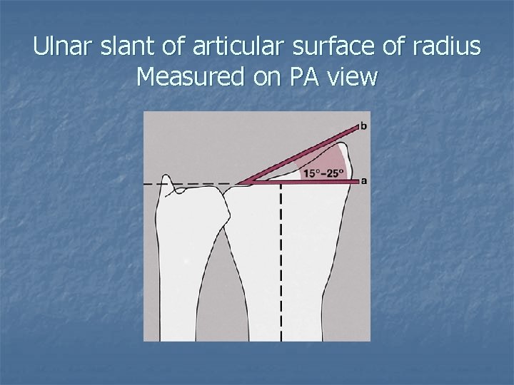 Ulnar slant of articular surface of radius Measured on PA view 