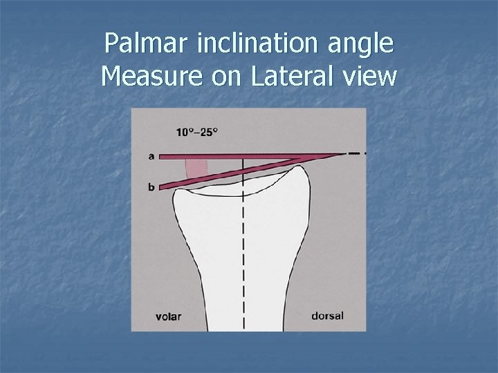 Palmar inclination angle Measure on Lateral view 