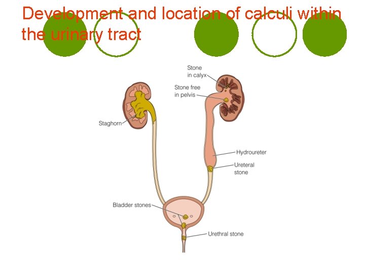 Development and location of calculi within the urinary tract 