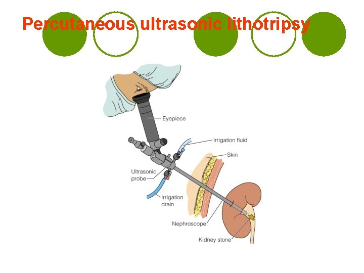 Percutaneous ultrasonic lithotripsy 