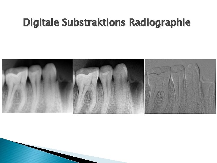 Digitale Substraktions Radiographie 