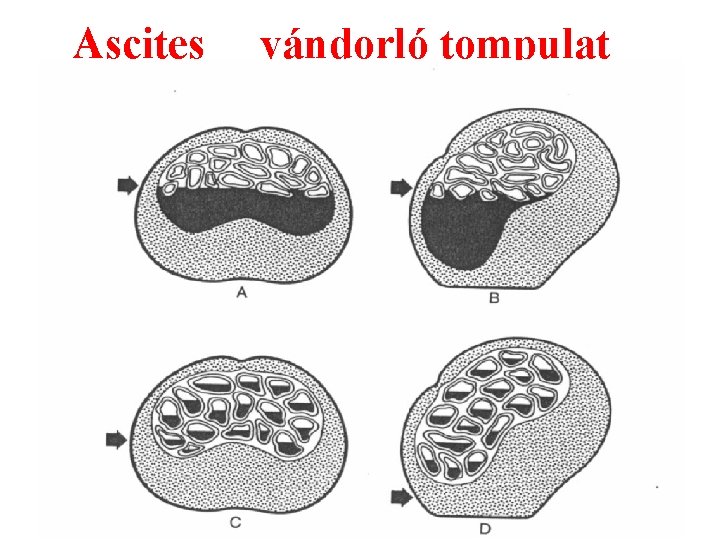 Ascites vándorló tompulat 