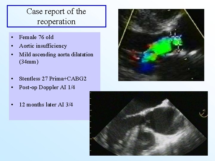 Case report of the reoperation • Female 76 old • Aortic insufficiency • Mild