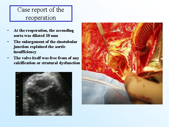 Case report of the reoperation • • • At the reoperation, the ascending aorta