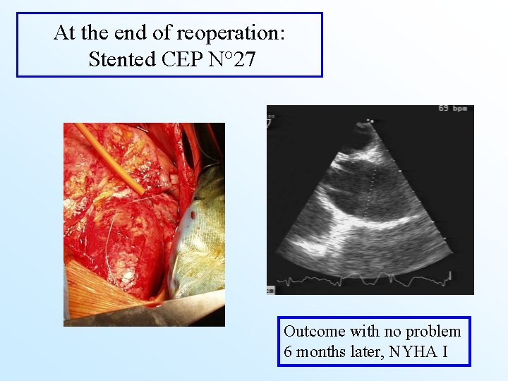 At the end of reoperation: Stented CEP N° 27 Outcome with no problem 6