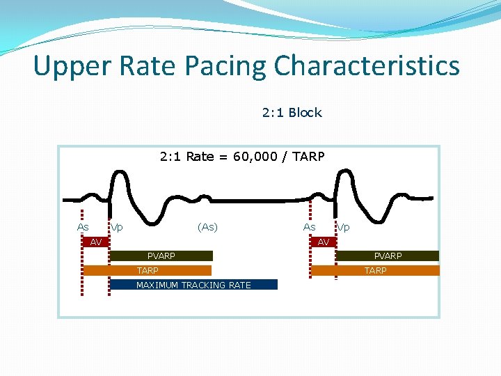 Upper Rate Pacing Characteristics 2: 1 Block 2: 1 Rate = 60, 000 /