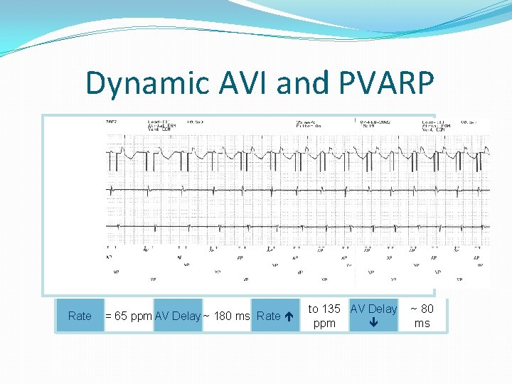 Dynamic AVI and PVARP Rate = 65 ppm AV Delay ~ 180 ms Rate