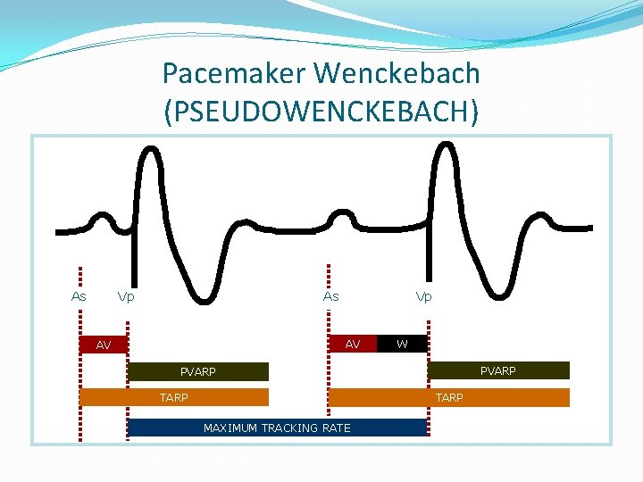 Pacemaker Wenckebach (PSEUDOWENCKEBACH) As Vp AV AV W PVARP TARP MAXIMUM TRACKING RATE 