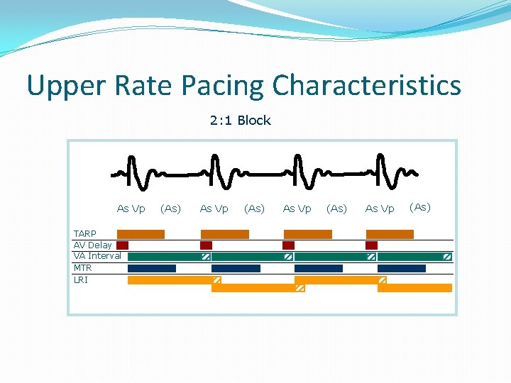 Upper Rate Pacing Characteristics 2: 1 Block As Vp TARP AV Delay VA Interval