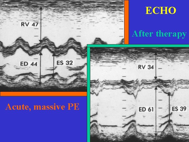 ECHO After therapy Acute, massive PE 