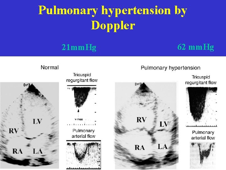 Pulmonary hypertension by Doppler 21 mm. Hg 62 mm. Hg 