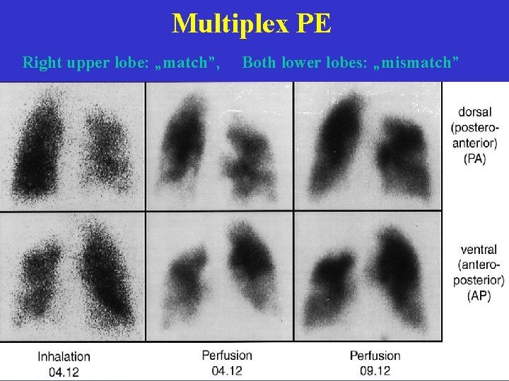 Multiplex PE Right upper lobe: „match”, Both lower lobes: „mismatch” 