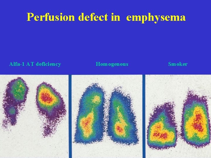 Perfusion defect in emphysema Alfa-1 AT deficiency Homogenous Smoker 