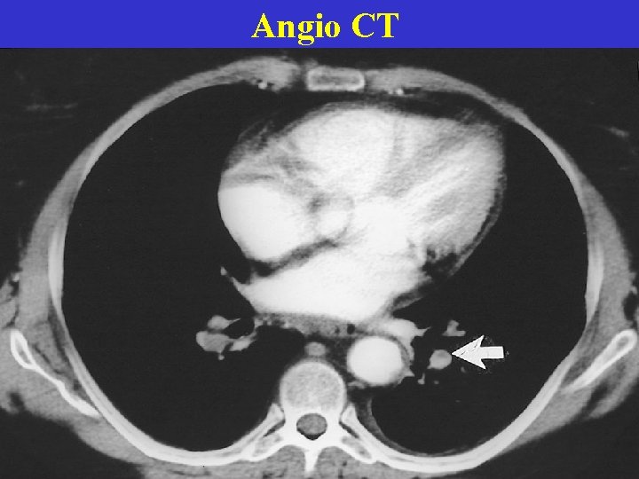 Angio CT 