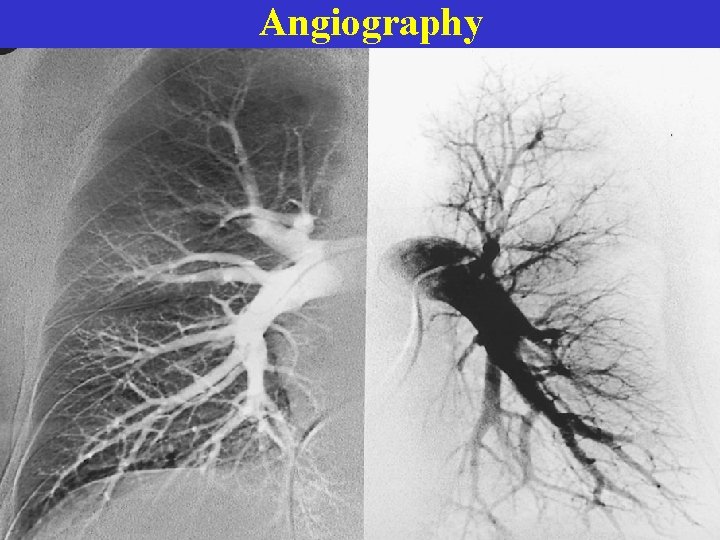 Angiography 