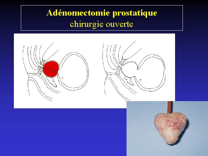 Adénomectomie prostatique chirurgie ouverte 