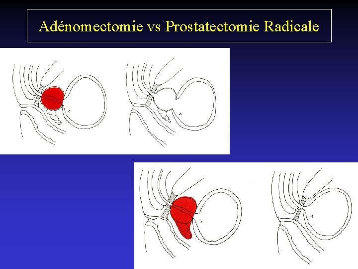 Adénomectomie vs Prostatectomie Radicale 