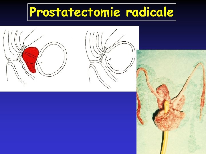 Prostatectomie radicale 