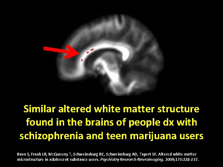 Similar altered white matter structure found in the brains of people dx with schizophrenia