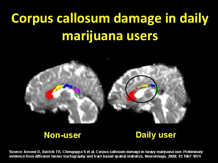 Corpus callosum damage in daily marijuana users Non-user Daily user Source: Arnone D, Barrick