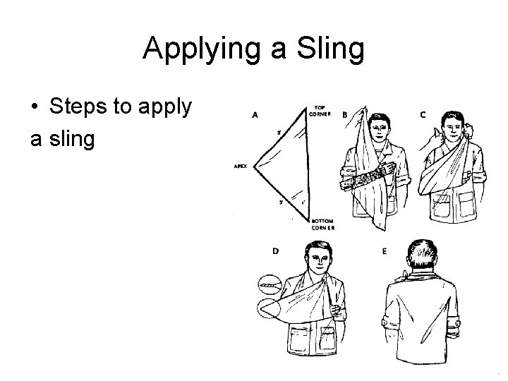 Applying a Sling • Steps to apply a sling 