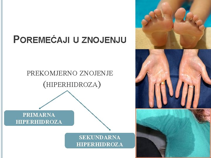 POREMEĆAJI U ZNOJENJU PREKOMJERNO ZNOJENJE (HIPERHIDROZA) PRIMARNA HIPERHIDROZA SEKUNDARNA HIPERHIDROZA 