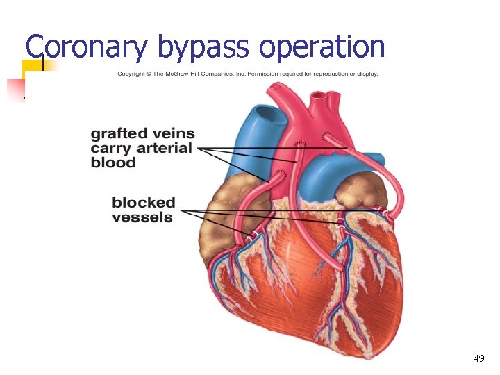 Coronary bypass operation 49 Coronary bypass operation 49