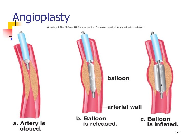 Angioplasty 50 Angioplasty 50