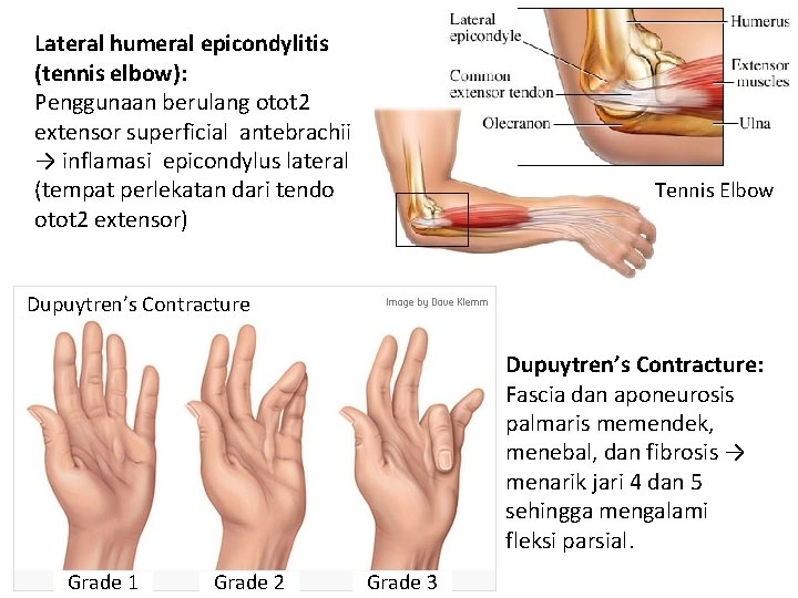 Lateral humeral epicondylitis (tennis elbow): Penggunaan berulang otot 2 extensor superficial antebrachii → inflamasi