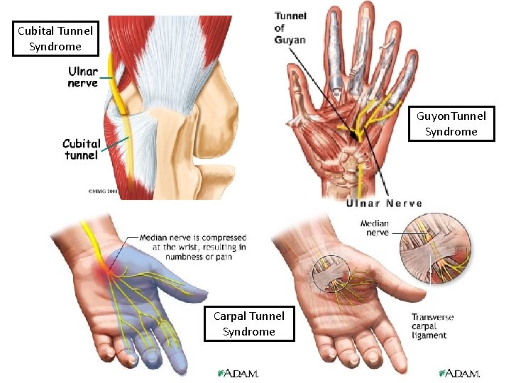 Cubital Tunnel Syndrome Guyon. Tunnel Syndrome Carpal Tunnel Syndrome 