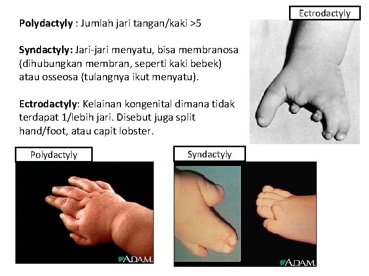 Polydactyly : Jumlah jari tangan/kaki >5 Syndactyly: Jari-jari menyatu, bisa membranosa (dihubungkan membran, seperti
