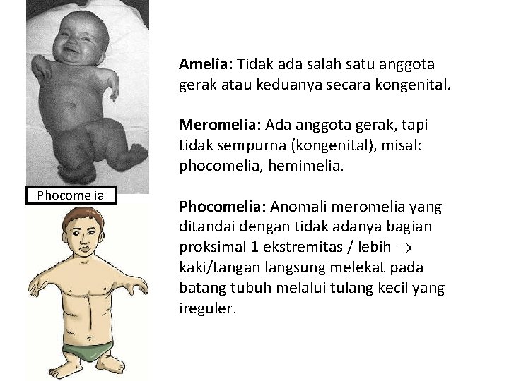 Amelia: Tidak ada salah satu anggota gerak atau keduanya secara kongenital. Meromelia: Ada anggota