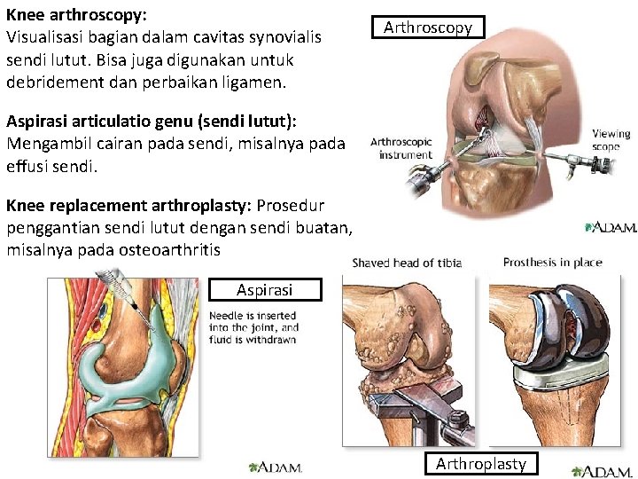 Knee arthroscopy: Visualisasi bagian dalam cavitas synovialis sendi lutut. Bisa juga digunakan untuk debridement