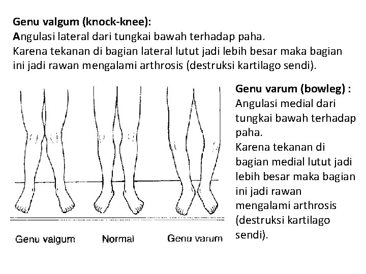 Genu valgum (knock-knee): Angulasi lateral dari tungkai bawah terhadap paha. Karena tekanan di bagian