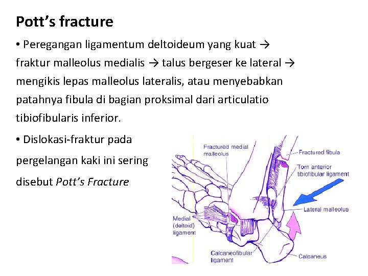 Pott’s fracture • Peregangan ligamentum deltoideum yang kuat → fraktur malleolus medialis → talus