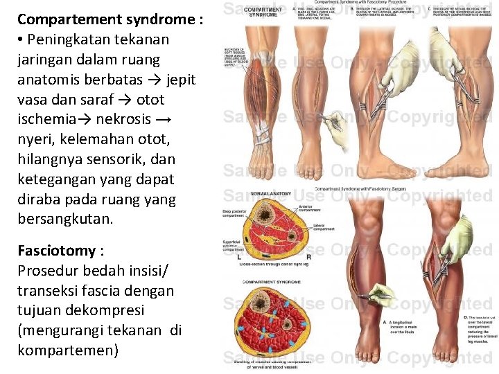 Compartement syndrome : • Peningkatan tekanan jaringan dalam ruang anatomis berbatas → jepit vasa