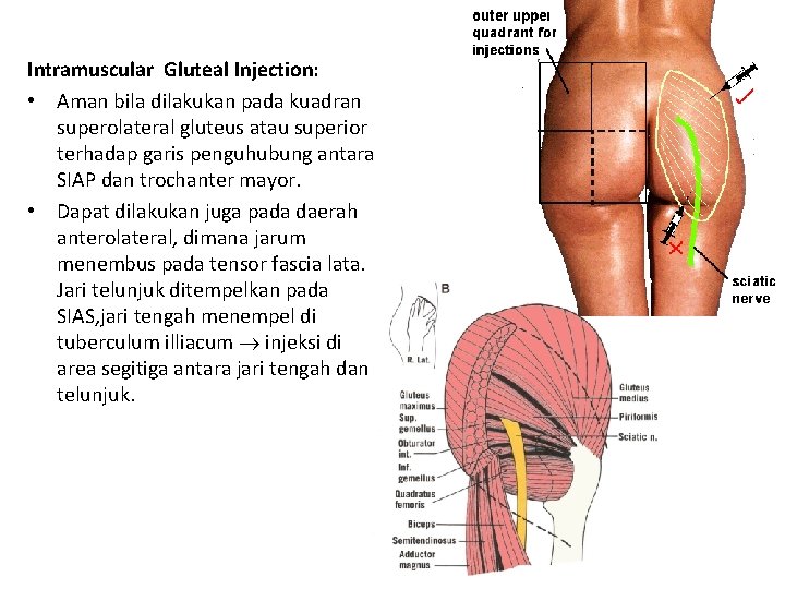 Intramuscular Gluteal Injection: • Aman bila dilakukan pada kuadran superolateral gluteus atau superior terhadap