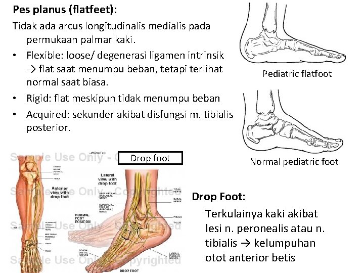 Pes planus (flatfeet): Tidak ada arcus longitudinalis medialis pada permukaan palmar kaki. • Flexible: