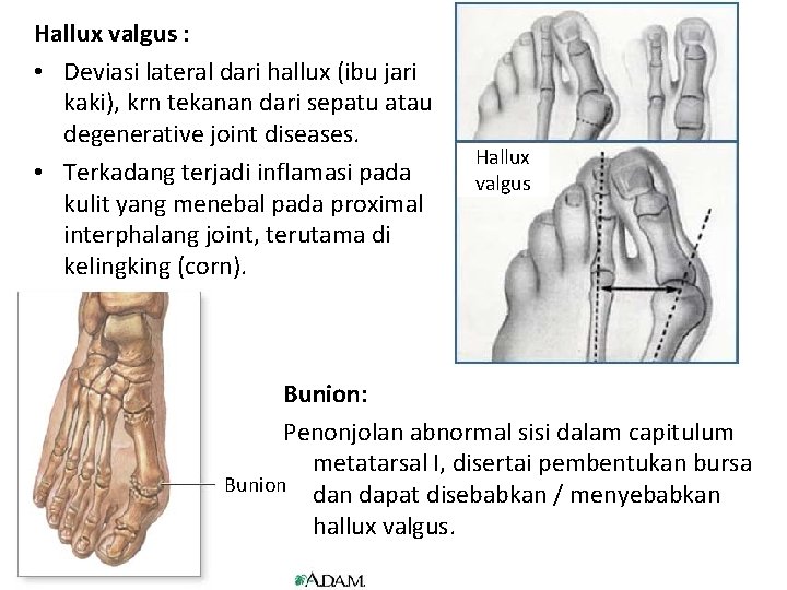 Hallux valgus : • Deviasi lateral dari hallux (ibu jari kaki), krn tekanan dari