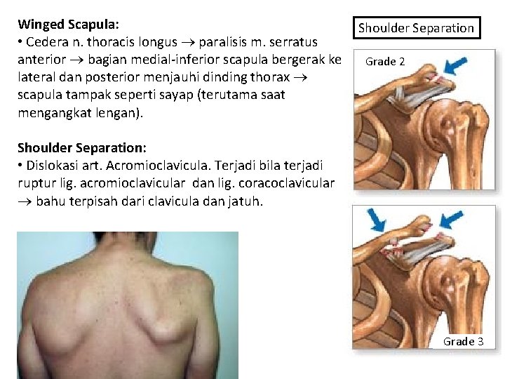 Winged Scapula: • Cedera n. thoracis longus paralisis m. serratus anterior bagian medial-inferior scapula