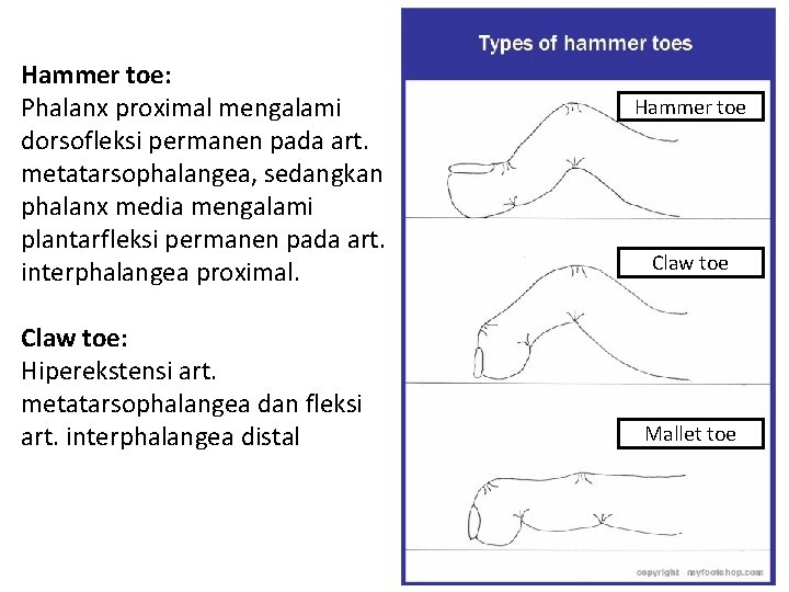 Hammer toe: Phalanx proximal mengalami dorsofleksi permanen pada art. metatarsophalangea, sedangkan phalanx media mengalami