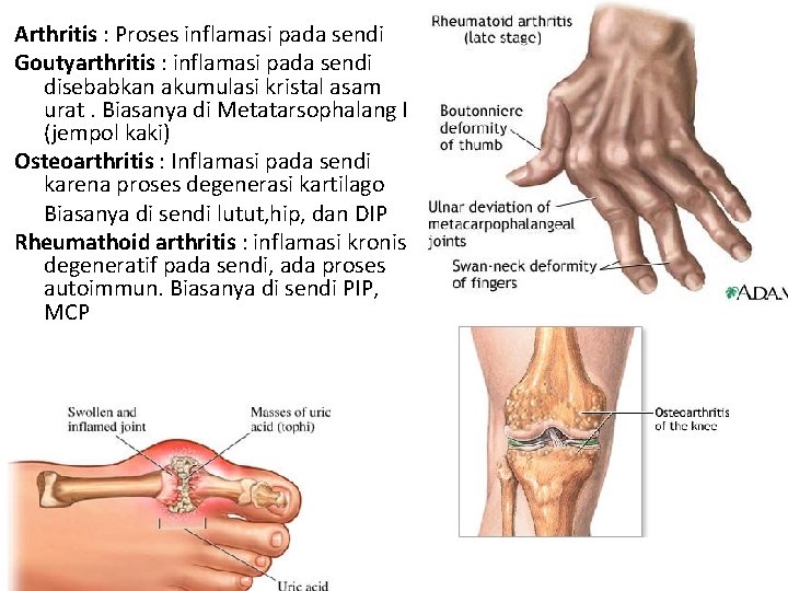 Arthritis : Proses inflamasi pada sendi Goutyarthritis : inflamasi pada sendi disebabkan akumulasi kristal