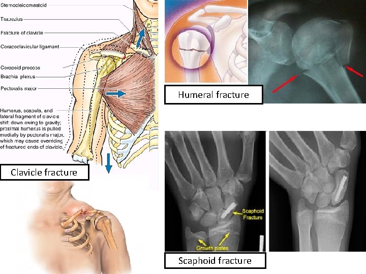 Humeral fracture Clavicle fracture Scaphoid fracture 