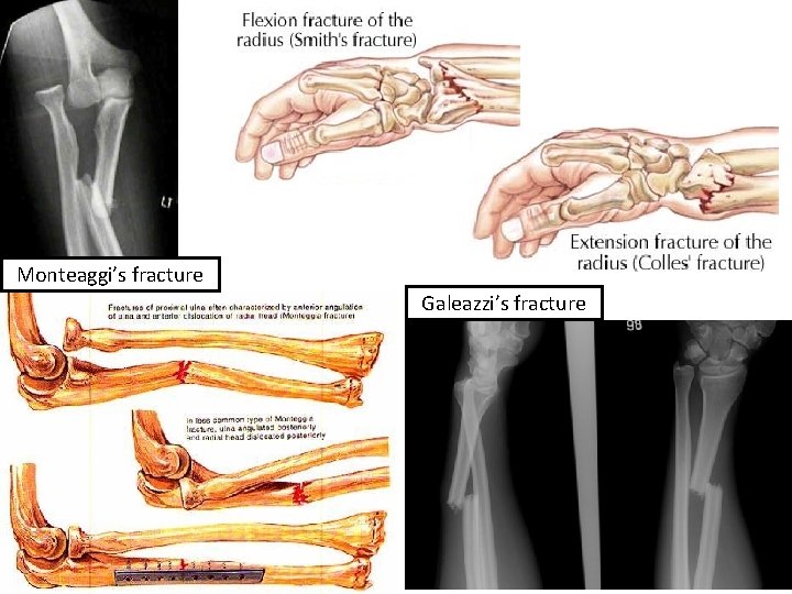 Monteaggi’s fracture Galeazzi’s fracture 