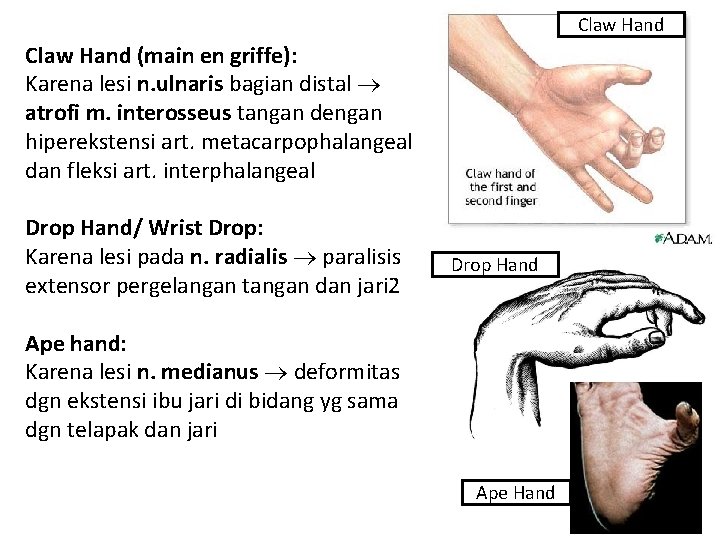 Claw Hand (main en griffe): Karena lesi n. ulnaris bagian distal atrofi m. interosseus