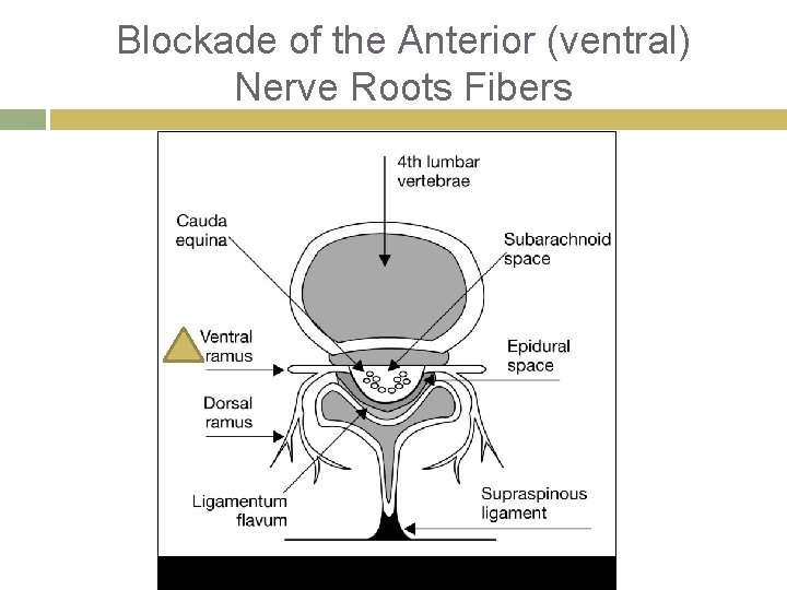 Blockade of the Anterior (ventral) Nerve Roots Fibers 